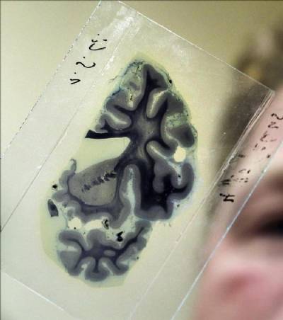 Spanish scientists develop vaccine to prevent Alzheimer's