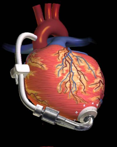 La Fe hospital's mechanical heart saves a man with a fortnight to live